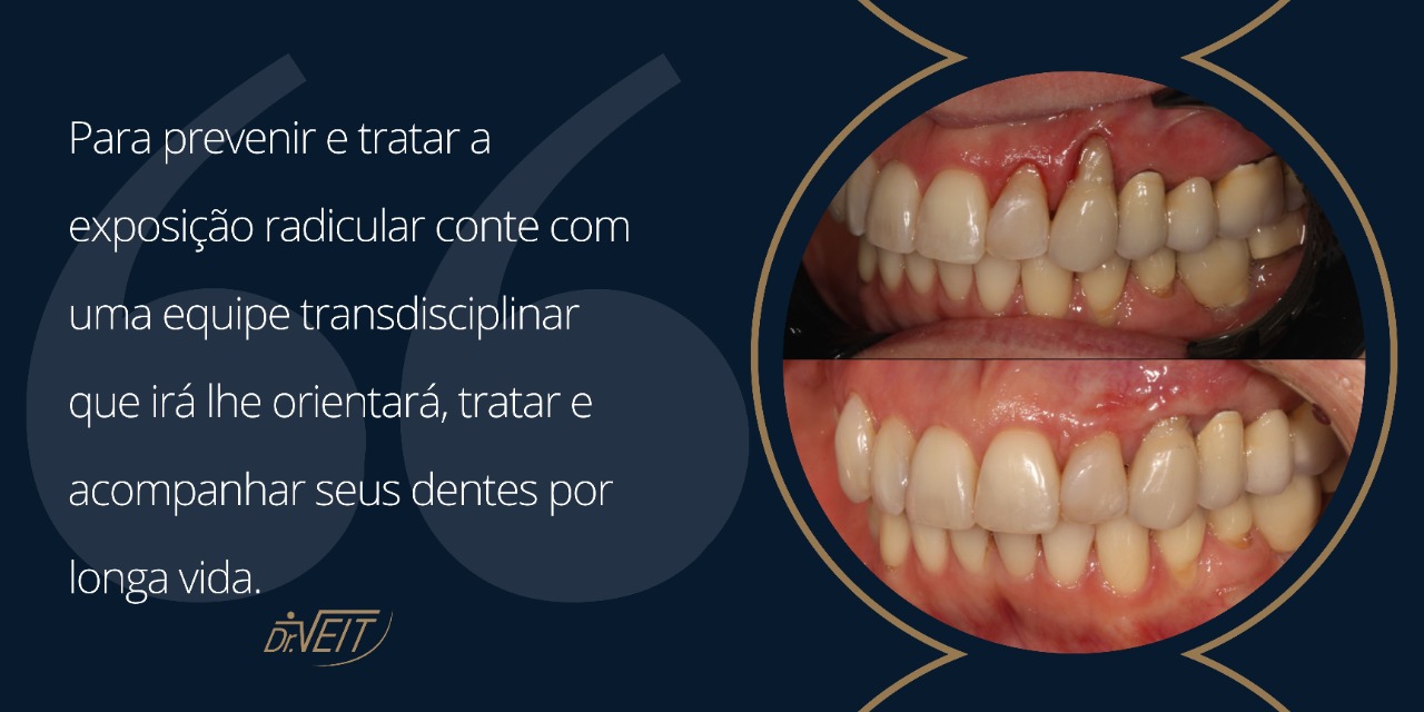 Minha raiz está exposta devo me preocupar