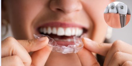 Tenho Implante mas quero usar aparelho, o que faço?