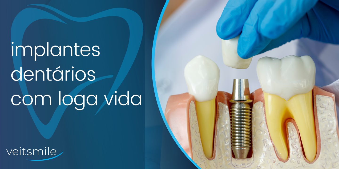 Vantagens dos implantes dentários