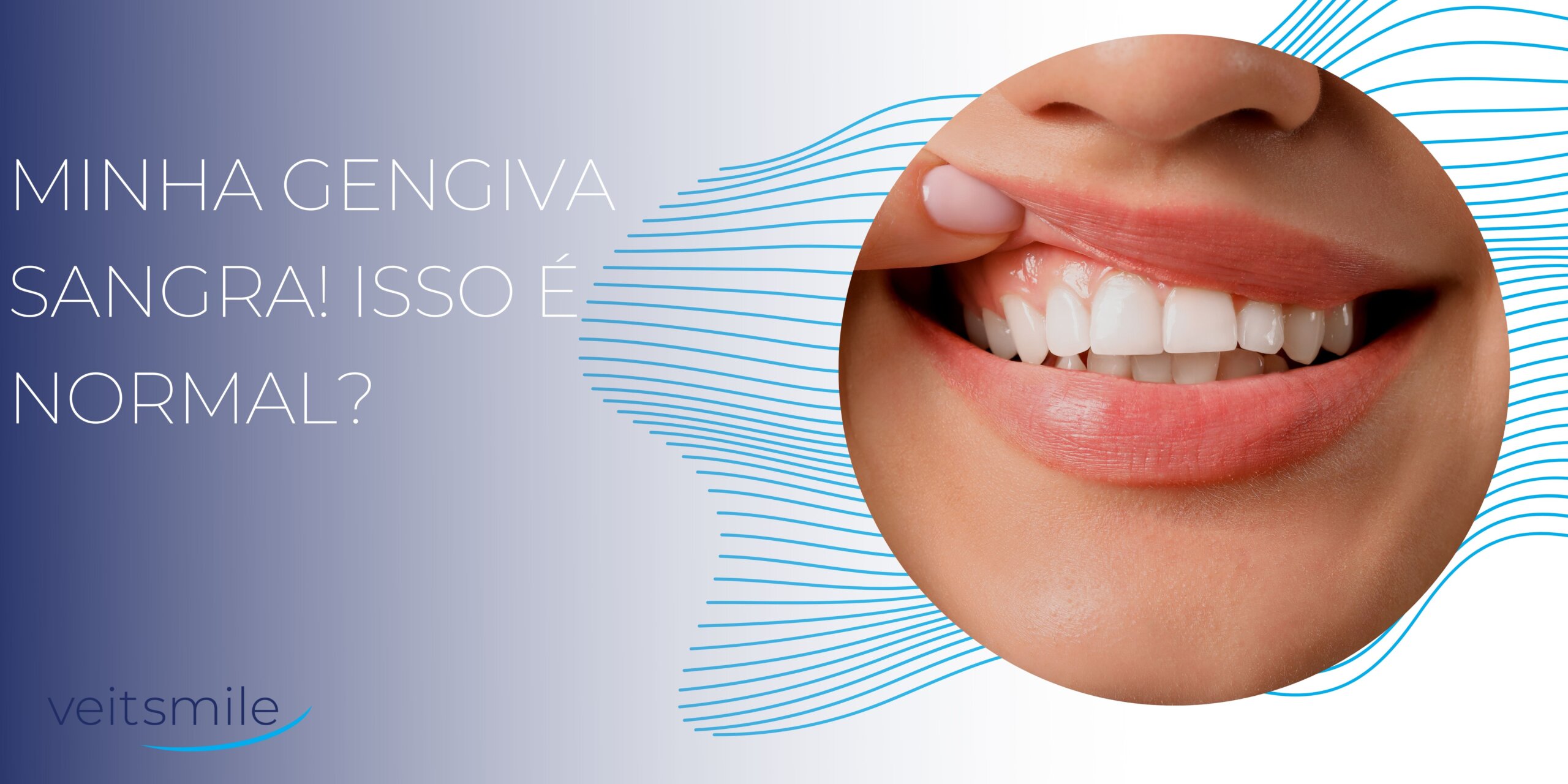 Quais são as causas do sangramento gengival