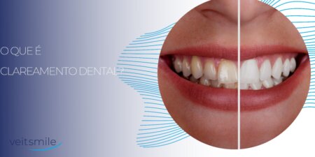Ausência de Dentes por muito tempo