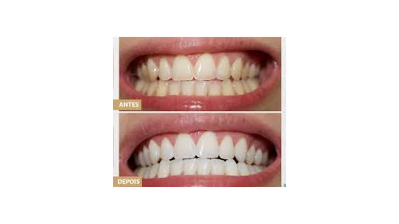 Alinhadores Transparentes Invisalign - Dr. Veit